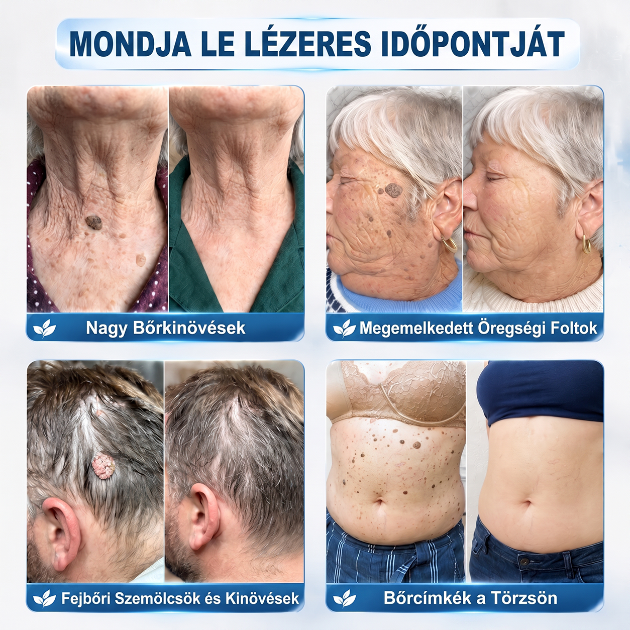 🌟Hivatalos Márkabolt | 🚢🚢 Hiskin® 7 napos Szemölcseltávolító Roll-on Ápoló Folyadék (Fájdalommentes rollerball technológia, hegek nélkül) 🐬