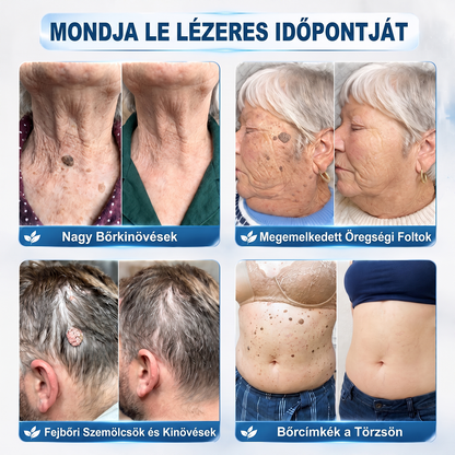 🌟Hivatalos Márkabolt | 🚢🚢 Hiskin® 7 napos Szemölcseltávolító Roll-on Ápoló Folyadék (Fájdalommentes rollerball technológia, hegek nélkül) 🐬