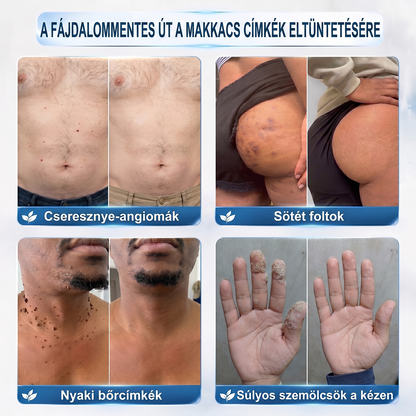 🌟Hivatalos Márkabolt | 🚢🚢 Hiskin® 7 napos Szemölcseltávolító Roll-on Ápoló Folyadék (Fájdalommentes rollerball technológia, hegek nélkül) 🐬