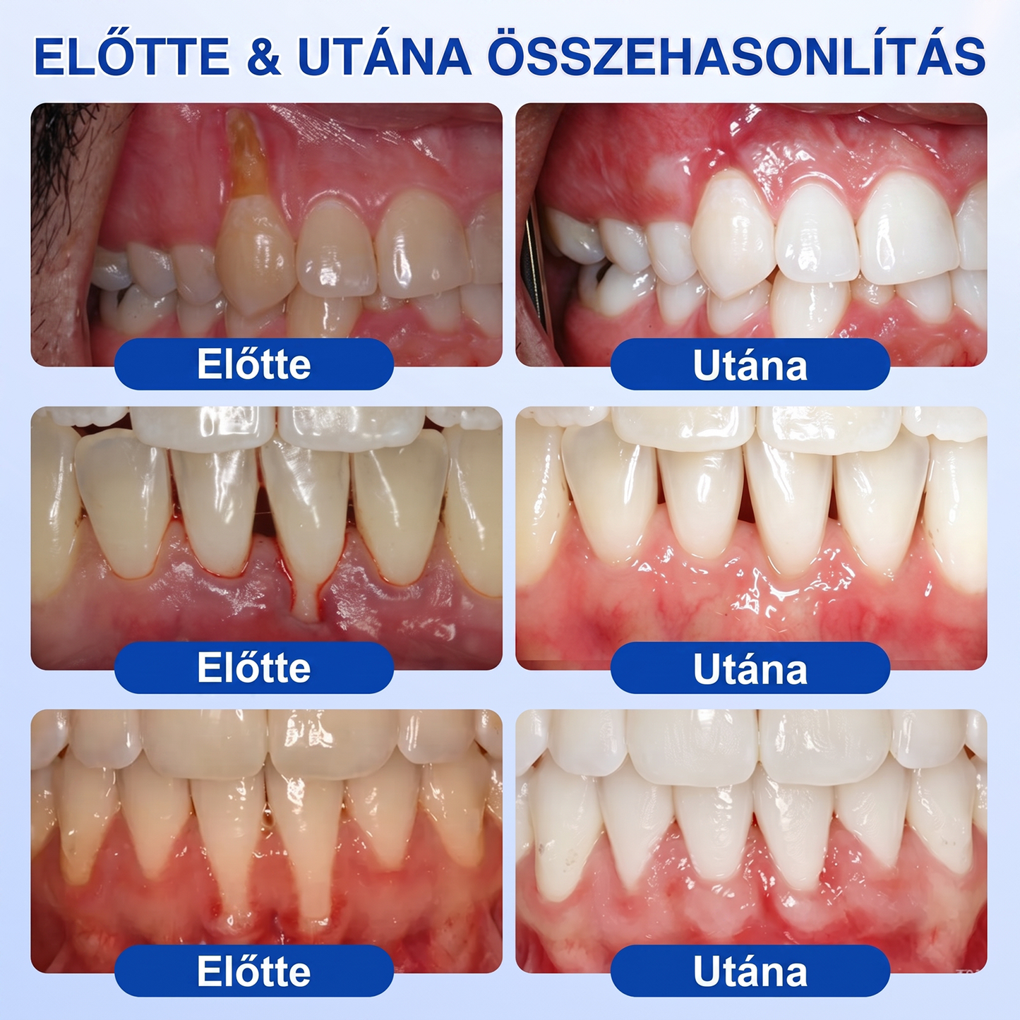 匈牙利牙齿🇭🇺🏅🦷🛡️ Dr.Era® GumRevive Parodontális Regeneráló Gél 💎（副本）