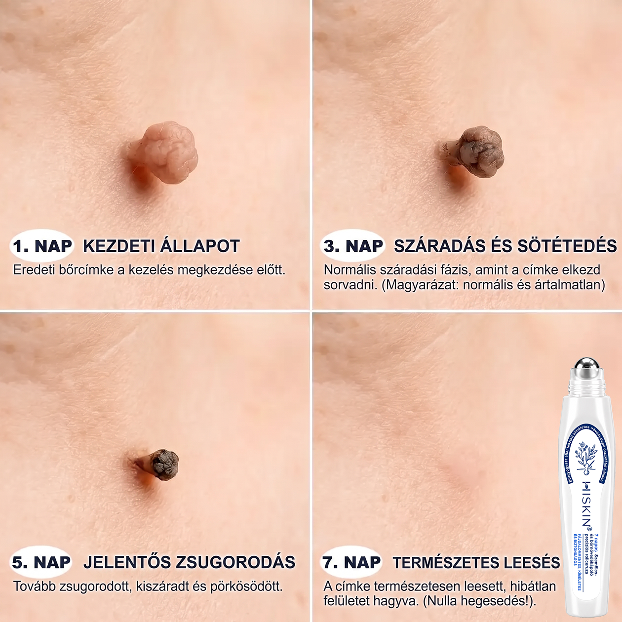 🌟Hivatalos Márkabolt | 🚢🚢 Hiskin® 7 napos Szemölcseltávolító Roll-on Ápoló Folyadék (Fájdalommentes rollerball technológia, hegek nélkül) 🐬