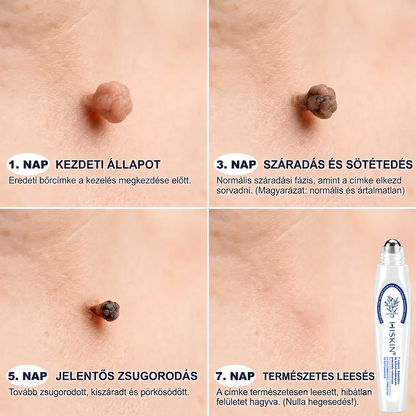 🌟Hivatalos Márkabolt | 🚢🚢 Hiskin® 7 napos Szemölcseltávolító Roll-on Ápoló Folyadék (Fájdalommentes rollerball technológia, hegek nélkül) 🐬