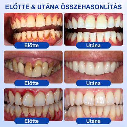 匈牙利牙齿🇭🇺🏅🦷🛡️ Dr.Era® GumRevive Parodontális Regeneráló Gél 💎（副本）