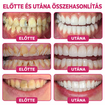 ⭐👨‍⚕️🦷HEATWOLF® DenPerm – Természetes fogzománc-töltő gél a fogszuvasodás helyreállítására🐟🐟