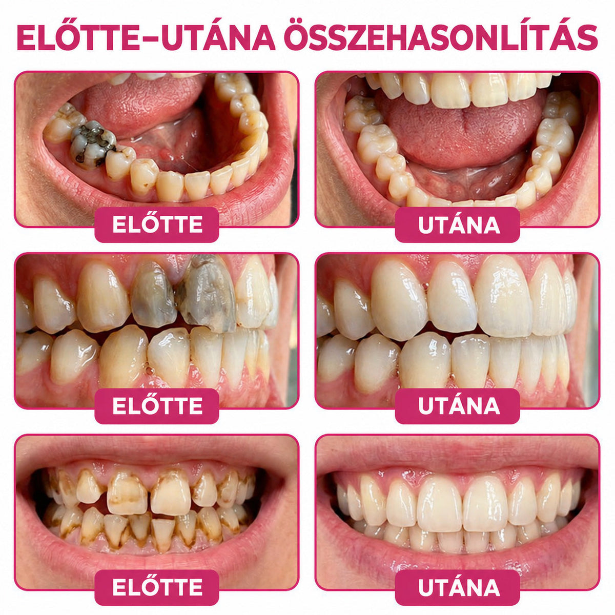 ⭐👨‍⚕️🦷HEATWOLF® DenPerm – Természetes fogzománc-töltő gél a fogszuvasodás helyreállítására🐟🐟